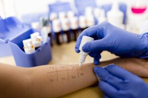 bigstock-Allergy-skin-prick-tests-62475659
